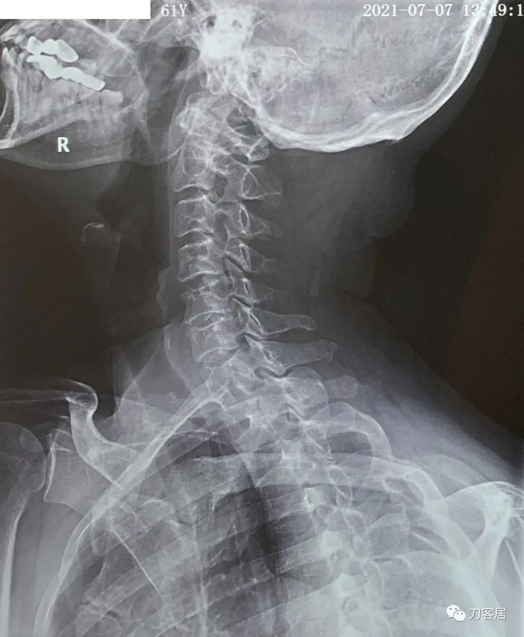 病例左侧躯体麻木,右侧肢体麻木典型病例