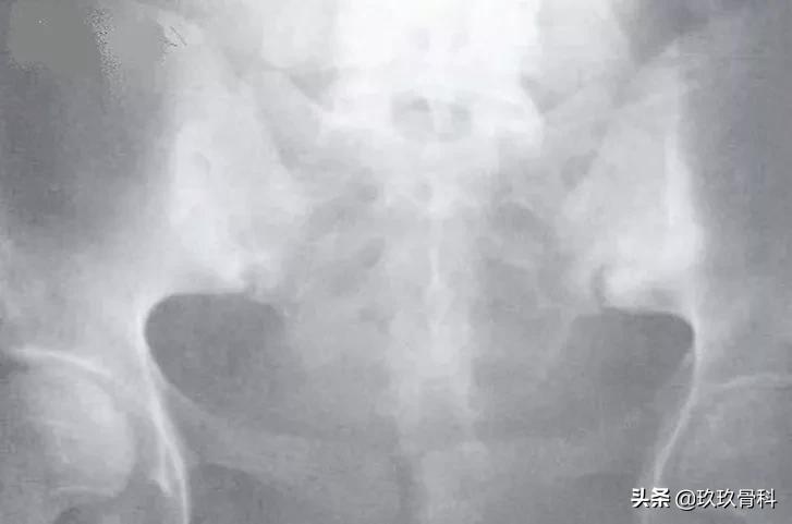 5岁小孩强直性脊柱炎的诊断,强直性脊柱炎诊断标准b27