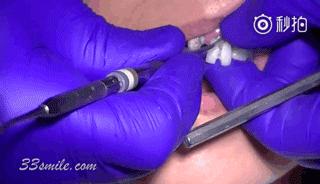 烤瓷牙做了人变丑了,烤瓷牙套里的牙烂了有什么症状