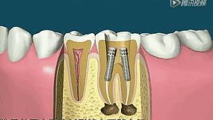 根管治疗后期症状,根管治疗全过程真的很痛吗