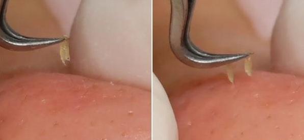 皮肤毛孔挤出黑的固体,皮肤干燥毛孔粗大该怎么解决