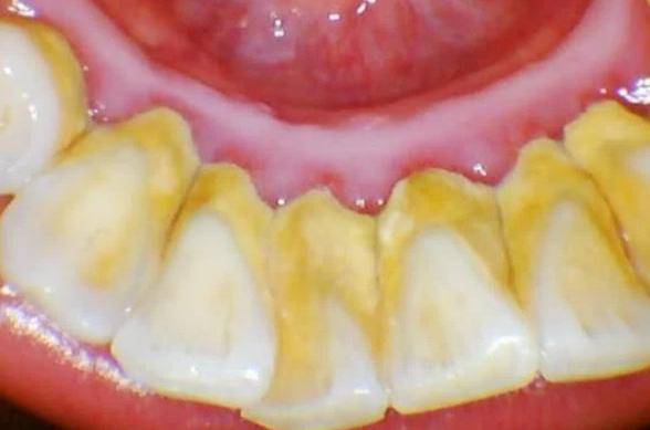 牙齿上的黄泥是什么,牙齿上的黄泥怎么去除