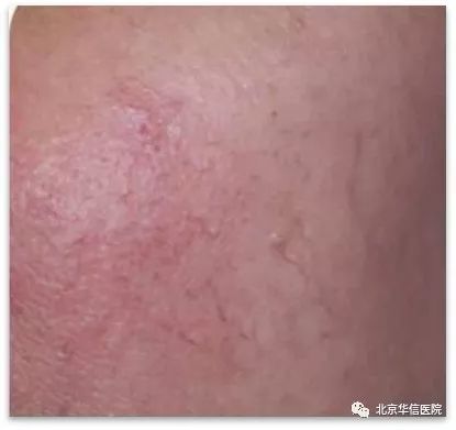 光子嫩肤帮你逆袭光滑细嫩状态,光子嫩肤让你拥有蛋壳般肌肤