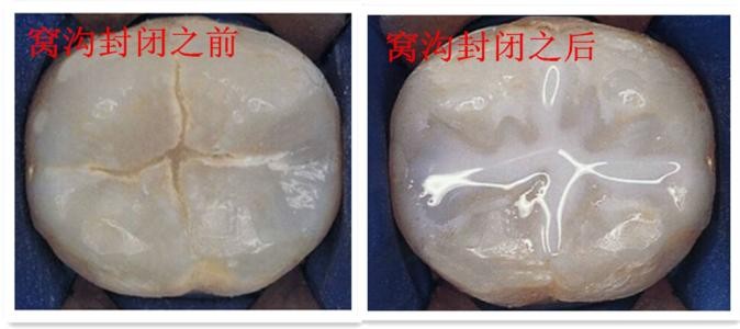 小孩全部蛀牙都需要补吗,9岁孩子蛀牙需要补牙吗