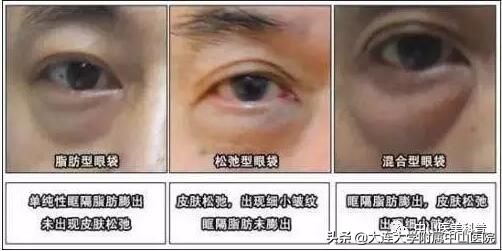 你有没有被自己的眼袋困扰过,关于眼袋的科普在这里