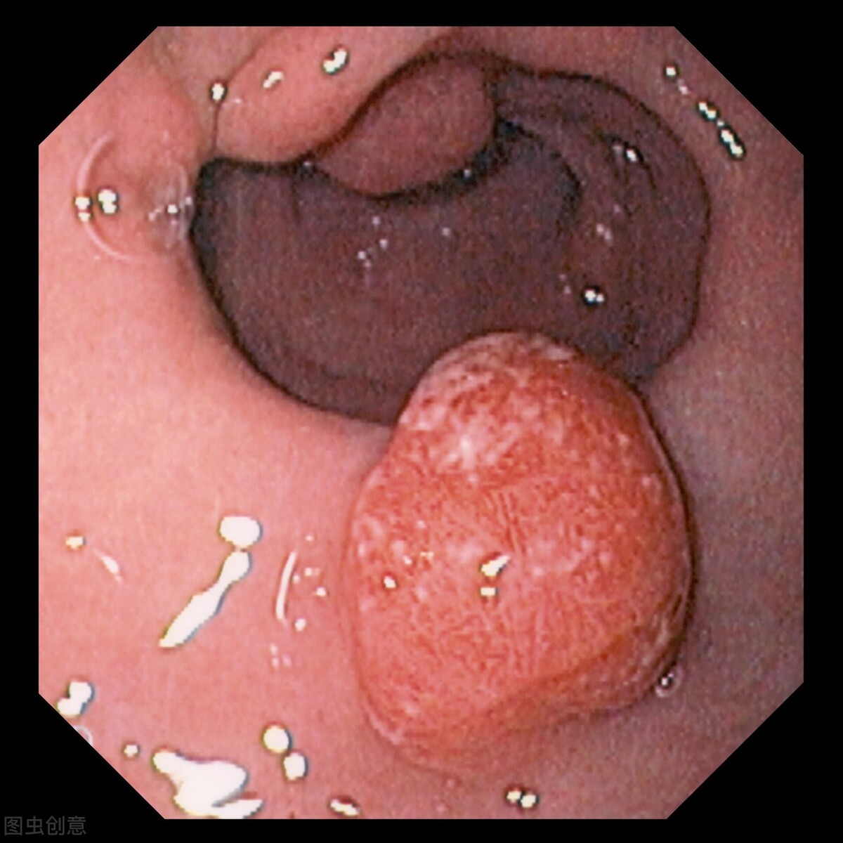 长了胃底腺息肉会不会癌变，到底要不要切？看这篇就够了