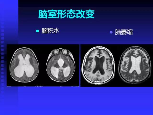 头颅mri读片视频教程,颅脑mri读片入门教程视频讲解全集