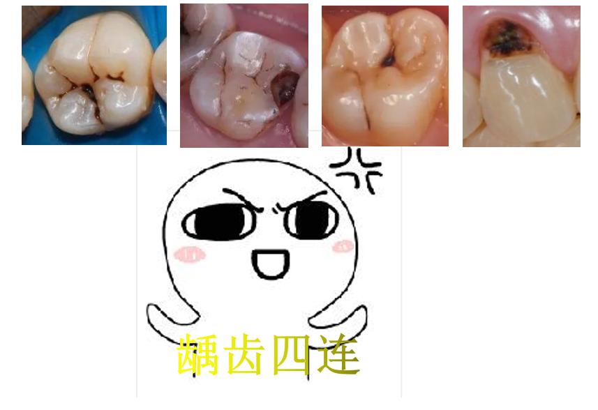 牙齿龋坏了怎么办,龋坏的牙齿治疗费用