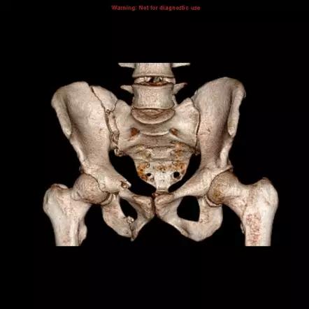 特殊骨折类型,特殊骨折体征