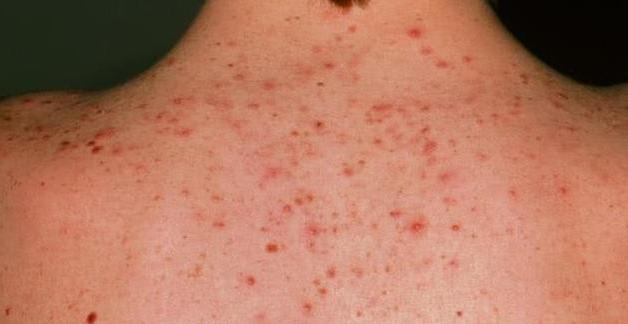 背后长痘痘除了螨虫还有什么原因,背上长螨虫痘痘的原因和解决方法