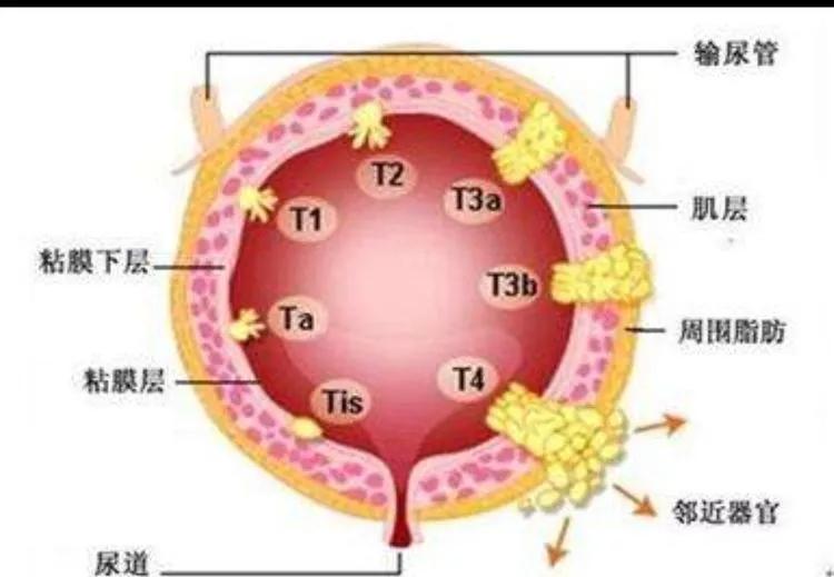 膀胱有肿瘤一定是癌症吗,通俗易懂讲解膀胱肿瘤