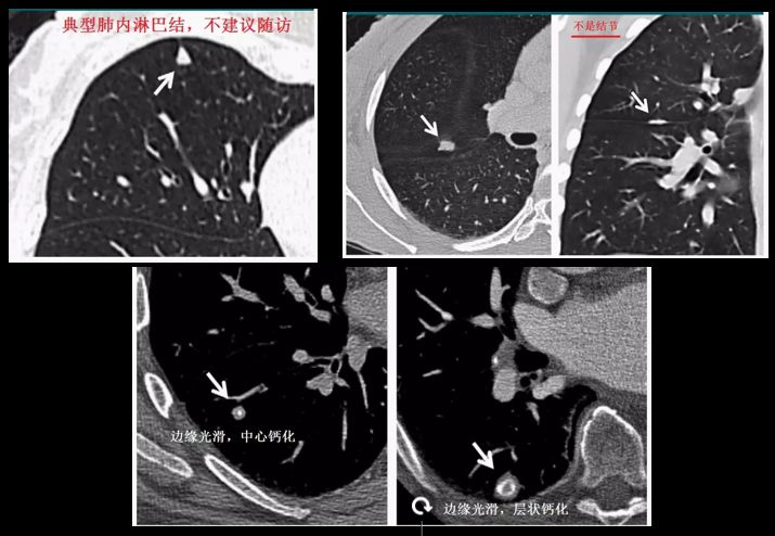 华西廖正银教授治肺结节,华西医院肺癌专家唐小军
