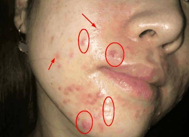 毛孔大是螨虫的原因吗,毛孔越来越多越来越大