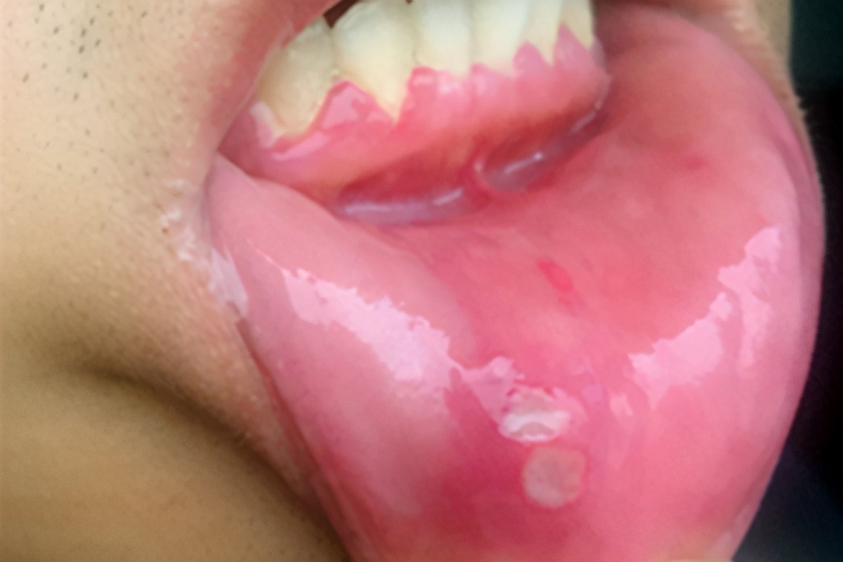 缺乏维生素b2吃了对身体有什么用,缺少维生素b2对身体有什么影响