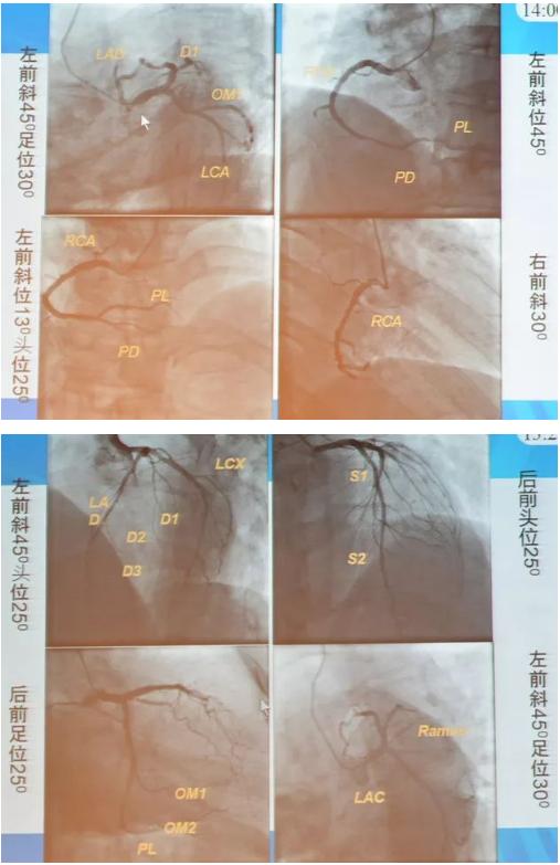 清晰完整揭秘冠脉造影全部过程,冠脉造影教学视频