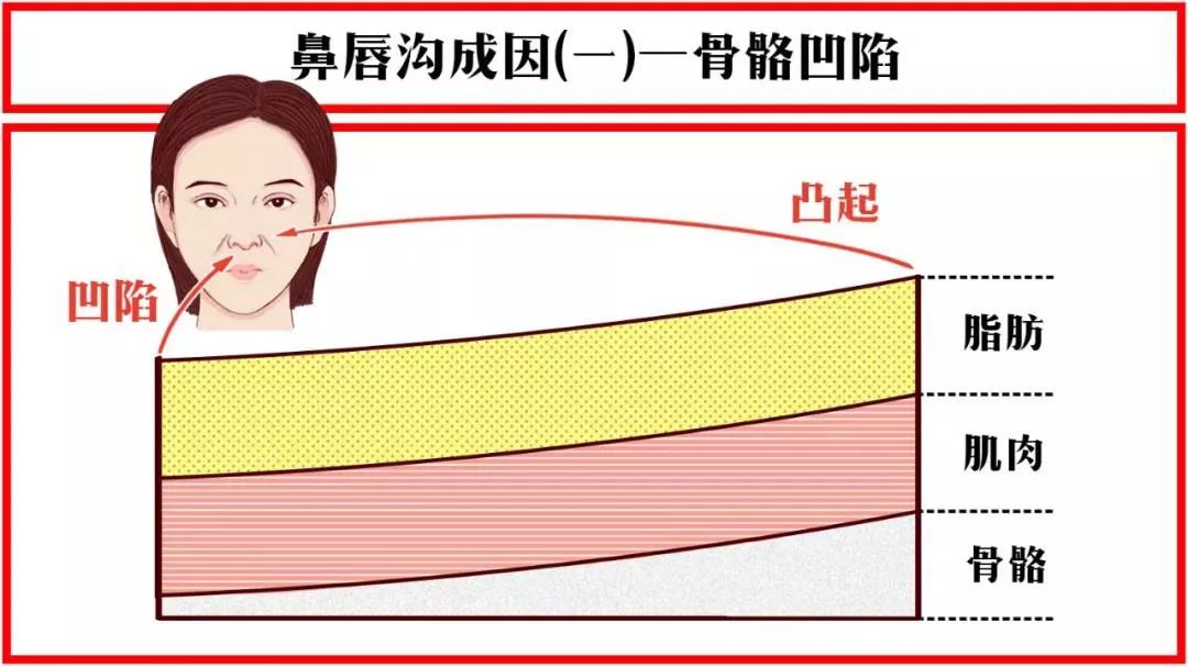 法令纹显老10岁三种方法帮助改善,最显老的法令纹怎么改善