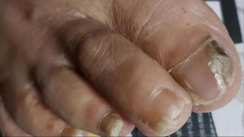 脚上真菌感染脱皮干裂怎么办,脚上脱皮又痒是真菌感染