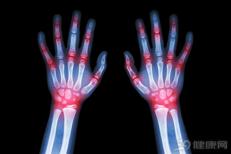 治类风湿的克星草药,有没有治类风湿的特效药