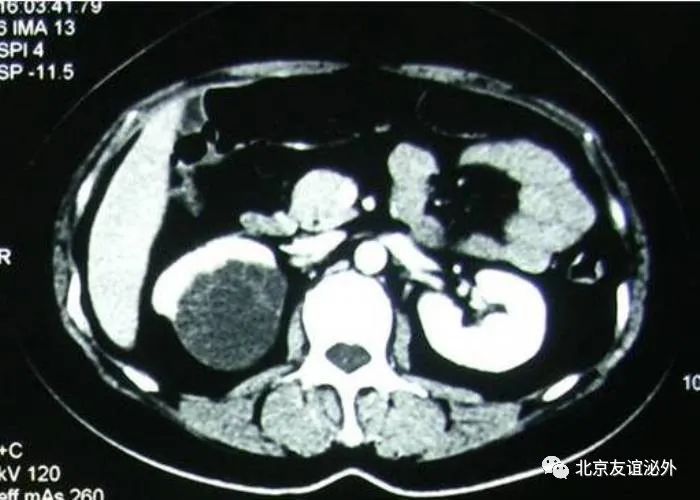 体检发现肾囊肿了怎么办?