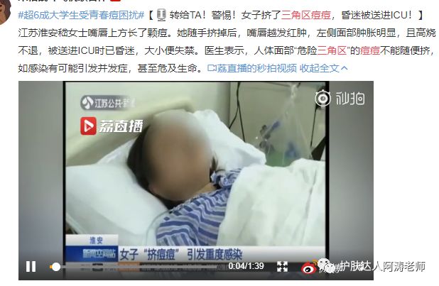 祛痘大揭秘远离痘痘困扰,祛痘小知识如何正确避免长痘痘