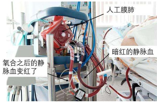 ecmo是危重症吗,ecmo能救猝死的人吗