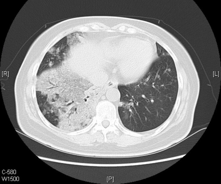 黏液腺癌基本不转移不复发,肺粘液腺癌转移了还能治好吗