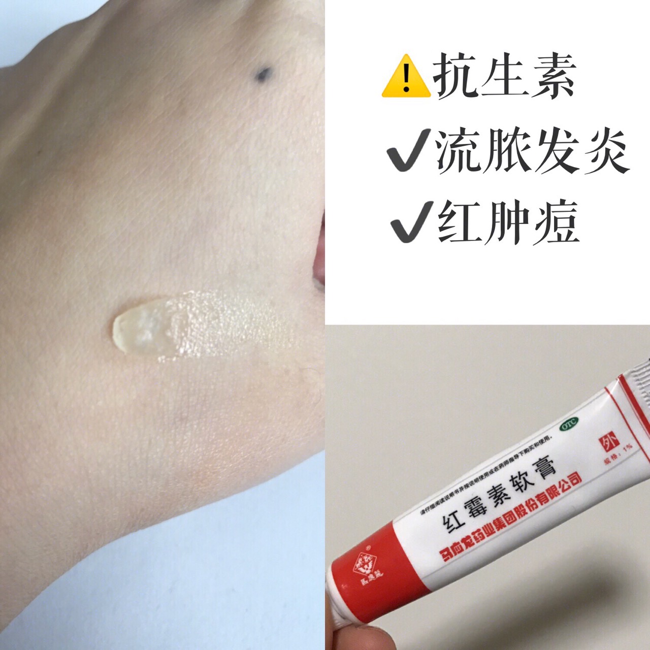 网上卖的十大祛痘药,女孩子必用的祛痘神器