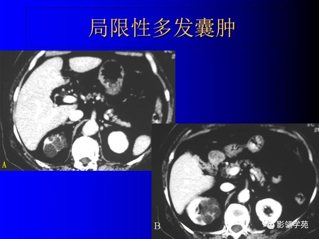肾脏囊性肿块的影像学特点,肾脏典型病理图片及解析