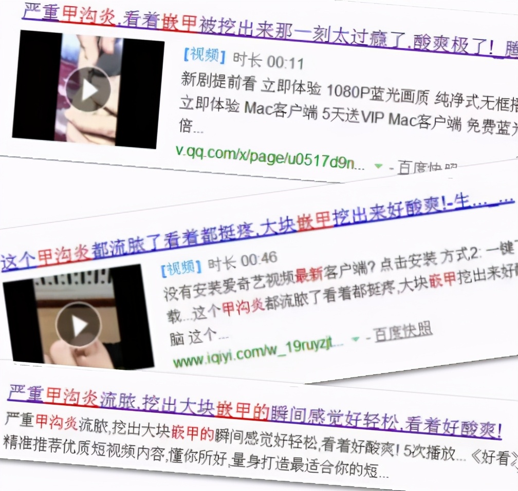 拔甲可以彻底治好嵌甲性甲沟炎吗,嵌甲甲沟炎拔了指甲还是红肿有脓