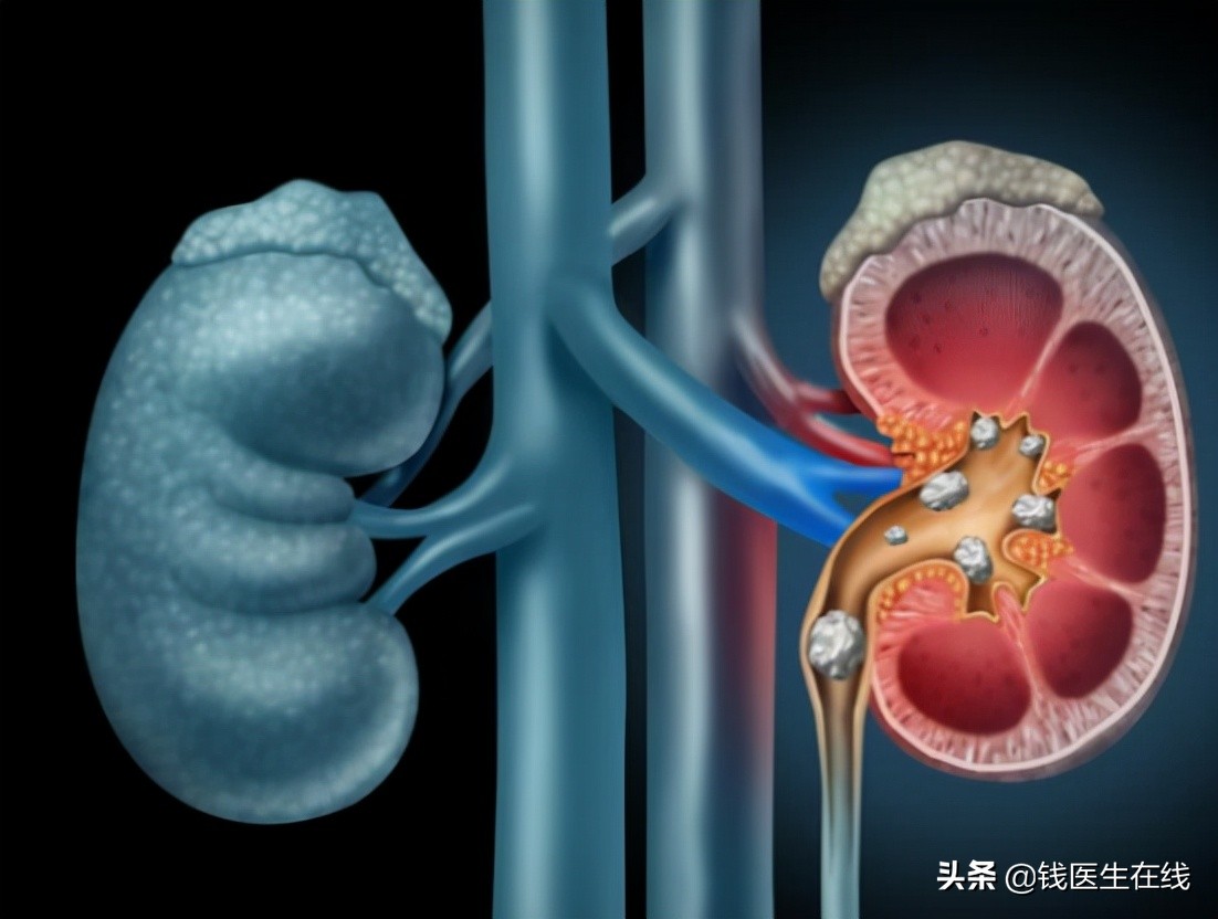 肾结石怎么才能消净,肾结石如何彻底解决问题