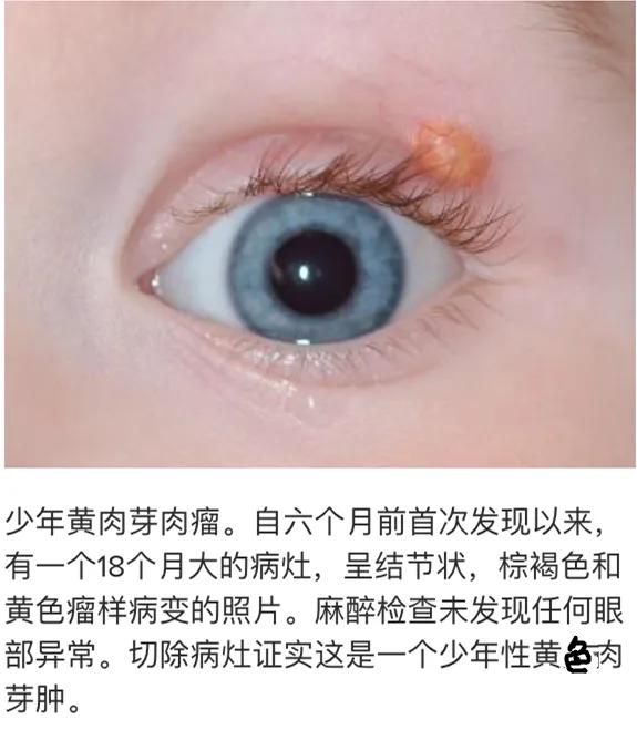 一岁孩子眼皮有几个疹子,小孩上眼皮长的像癣一样的东西