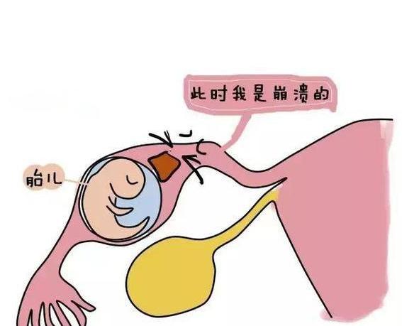 女人宫外孕一般是什么原因造成的,女性宫外孕是不是代表双方都正常