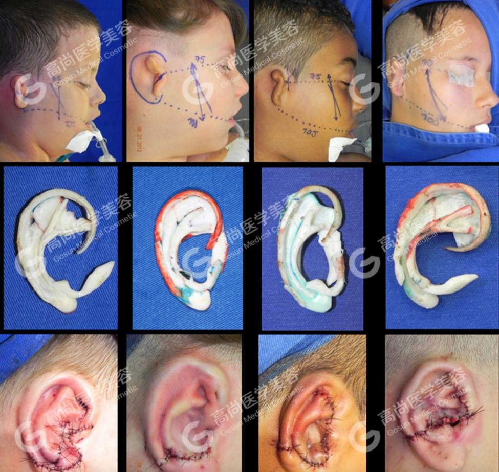 耳再造手术取肋软骨,耳再造剩下的肋软骨还放回去吗