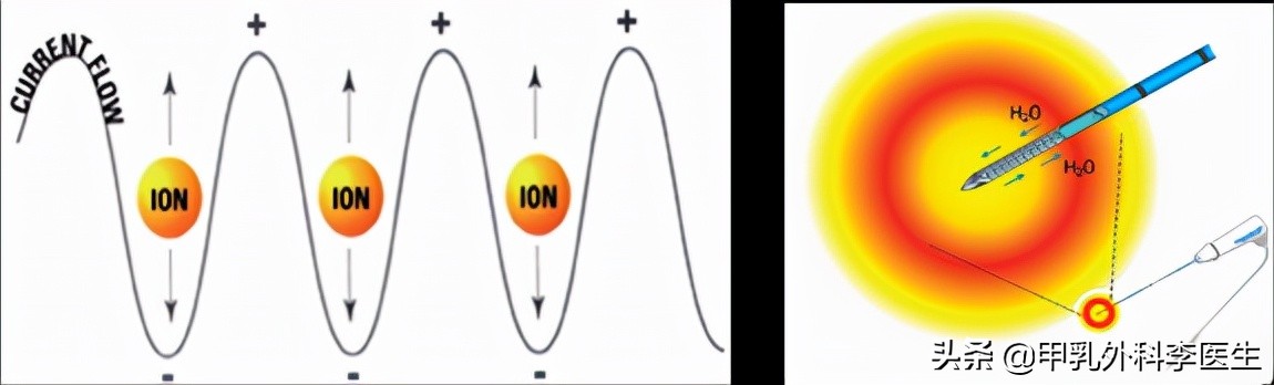 消融术治疗甲状腺结节要多久能好,甲状腺开刀还是消融术