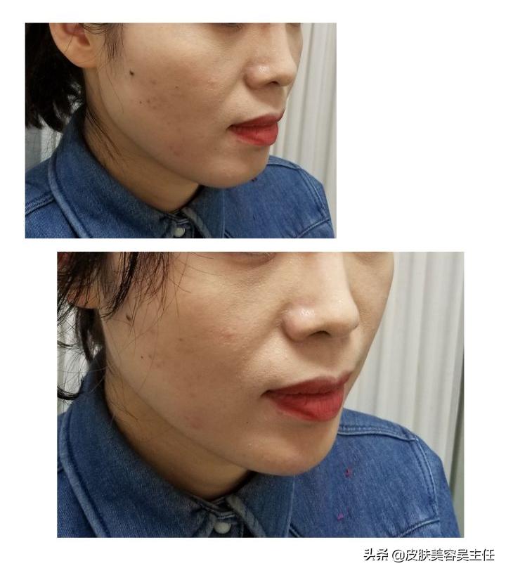 打玻尿酸成假脸,注射玻尿酸后出现假脸