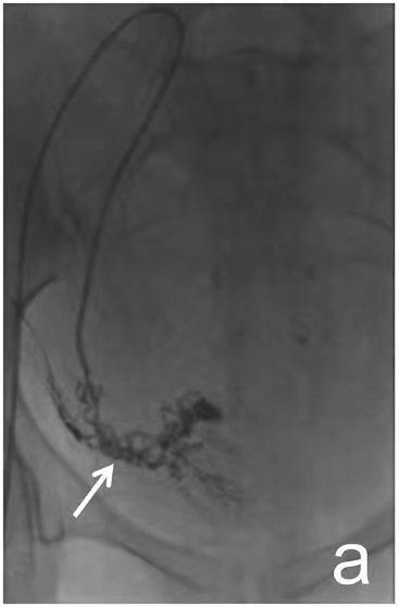 举例科普|介入能治疗哪些疾病?