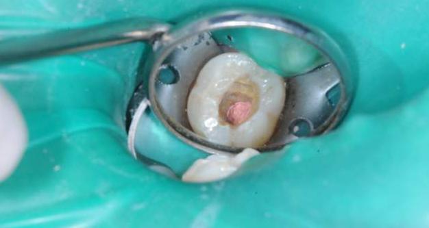 根管治疗是牙的什么问题,根管治疗真的是无法承受之痛吗