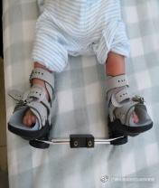 马蹄内翻足孩子的康复,成人马蹄足内翻康复治疗