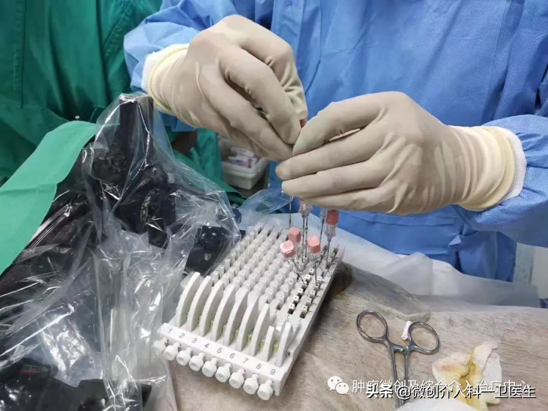 四川肿瘤医院碘125粒子植入术,肿瘤碘125粒子植入术图片