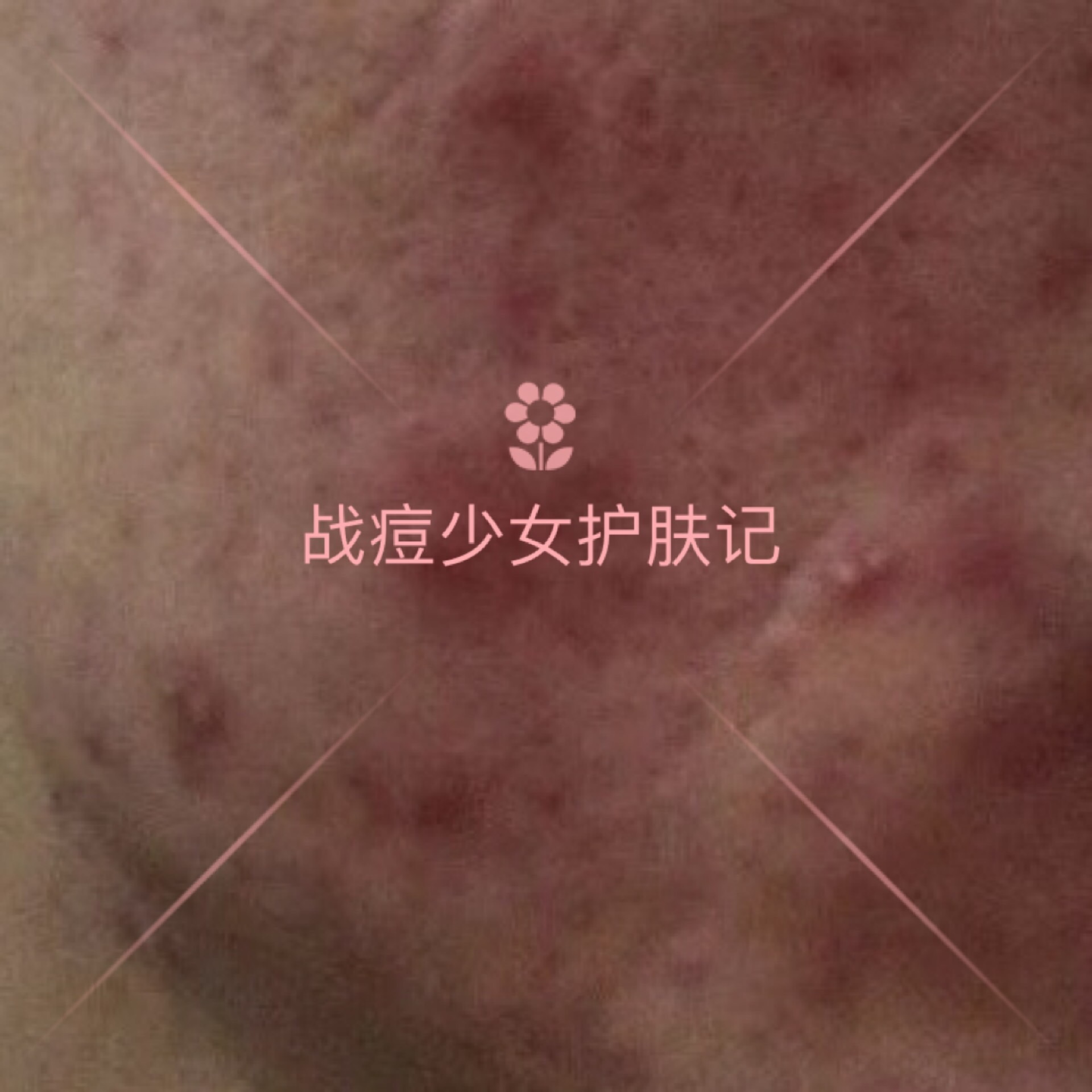 各种类型的痘痘怎么祛痘,痘痘六种类型上集