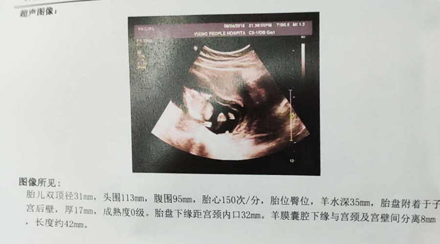 熊猫血妈妈产检,怀孕妈妈的艰难生产过程