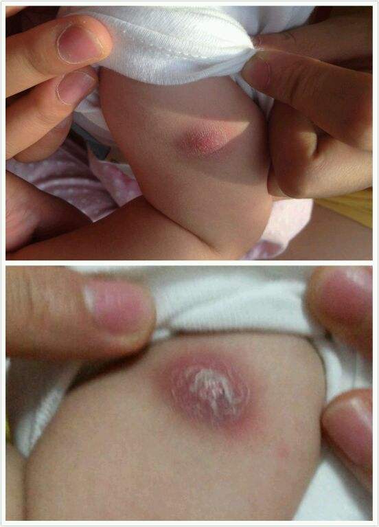 宝宝胳膊长了小疙瘩,妈妈着急坏了,医生居然说是正常反应?