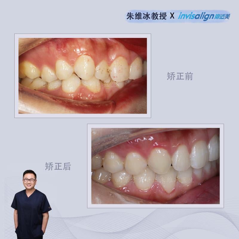 牙齿重度拥挤不拔牙正畸成功案例,南京牙齿矫正舌侧