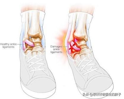 踝关节扭伤注意事项有哪些,踝关节轻微扭伤也会再次扭伤吗