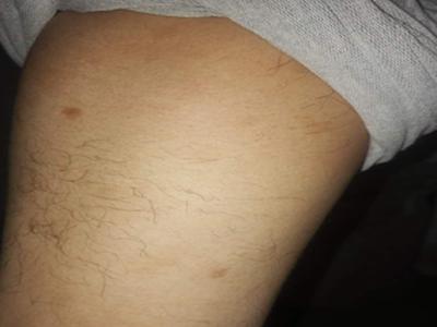 秋冬季节怎么预防银屑病复发,银屑病冬季防护用什么药