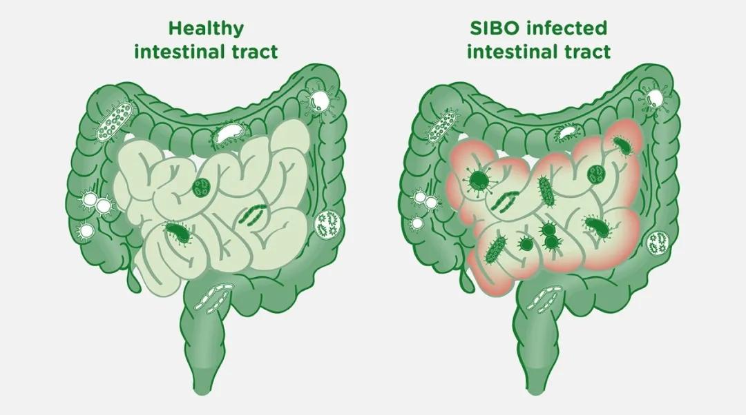 肠道菌群失调会得癌症吗,胃肠道菌群失调什么症状