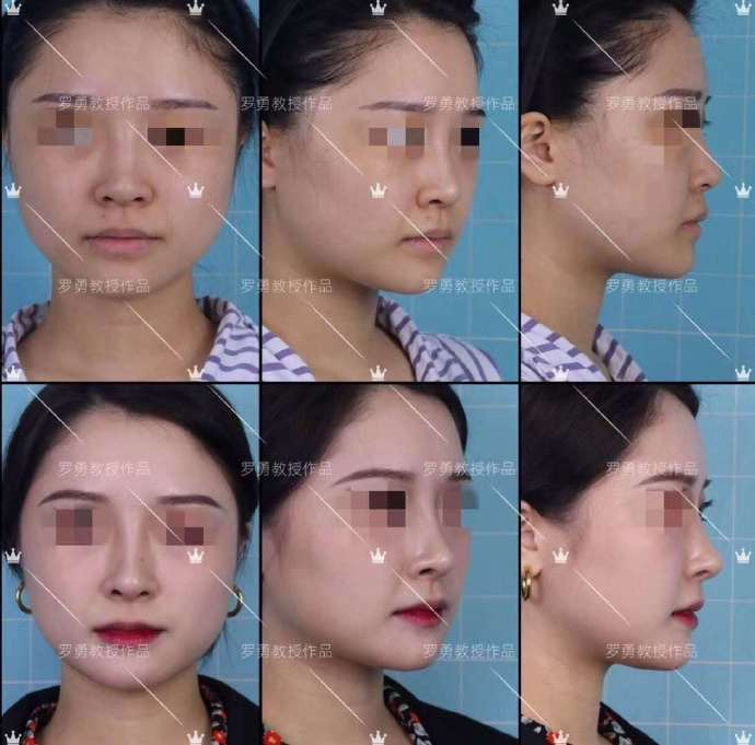 鼻整形之后怎么调理,鼻子整形修复注意事项