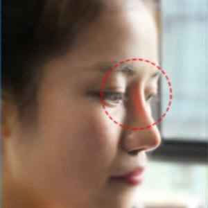 2022年流行鼻整形的全过程视频,大宽鼻手术案例