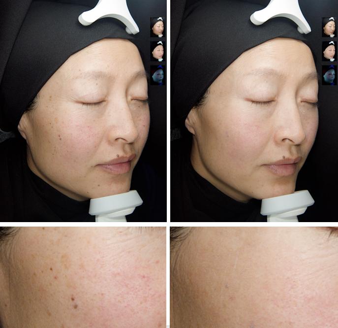 瞬间让脸变白的神器,让斑快速消失