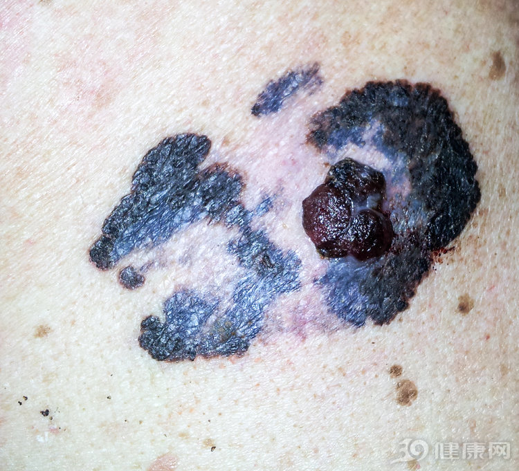 痣化脓出血了是不是癌变了,黑色素痣是否都会发展到癌